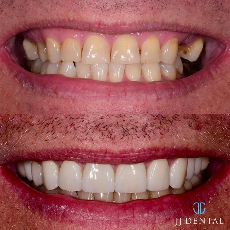 Dental implant before and after — case 2