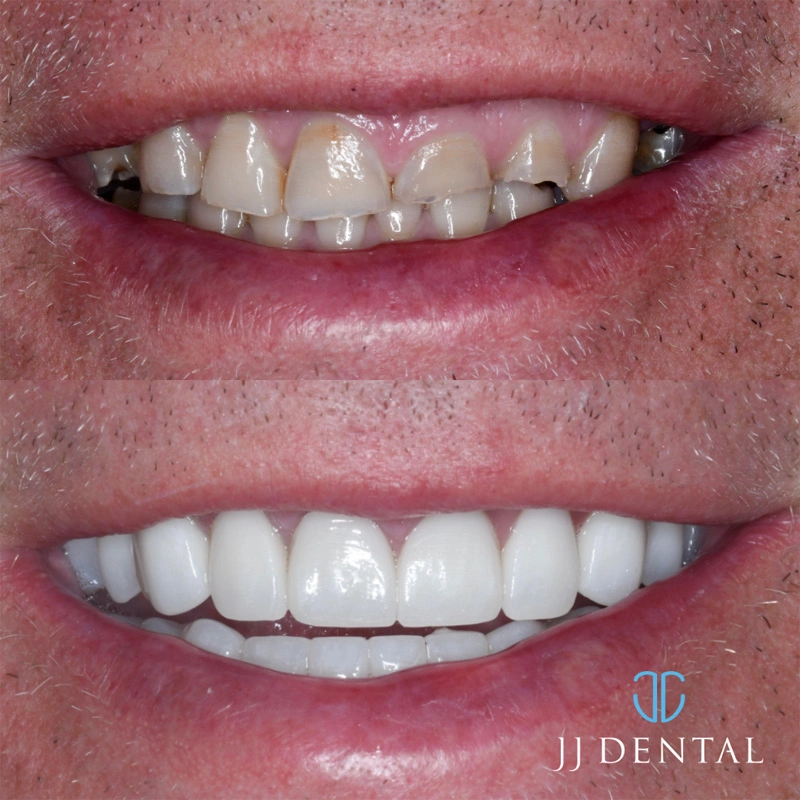 Dental implant before and after — case 4